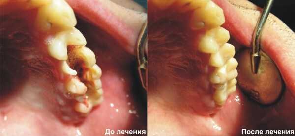 Фото лечение зубов до и после фото